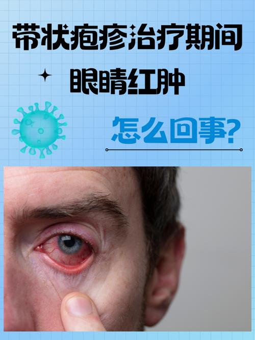 与风湿病相关的风湿眼病