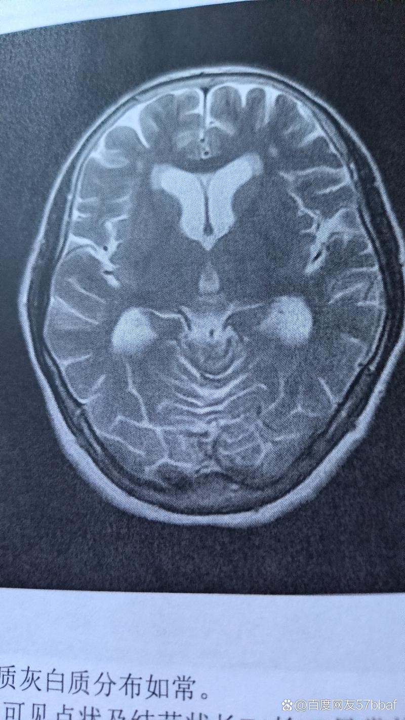 双侧脑旁多发缺血脑梗灶