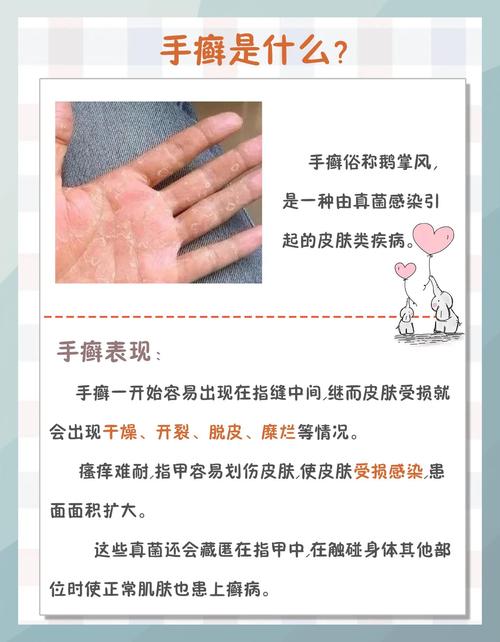 手有风湿 类风湿怎么办