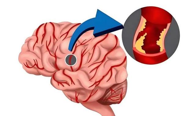 脑梗去脑强直能存活多久