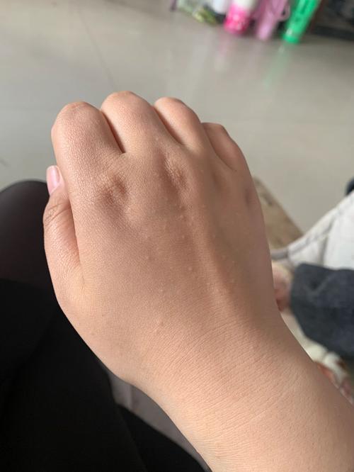 风湿类风湿手背出现长包