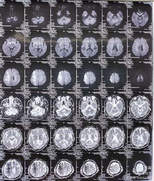 做脑核磁说稍微有点脑梗