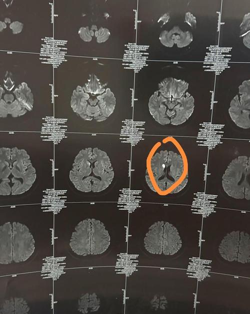 做脑核磁说稍微有点脑梗