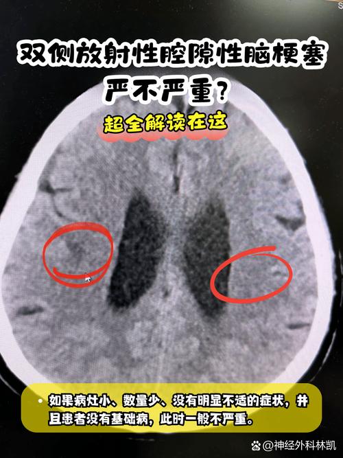 做脑核磁会不会造成脑梗