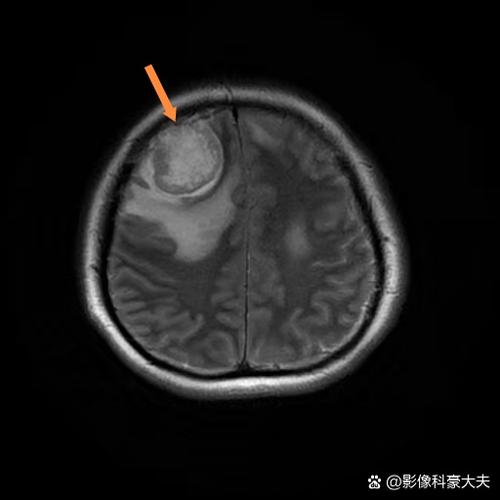 做脑核磁会不会造成脑梗