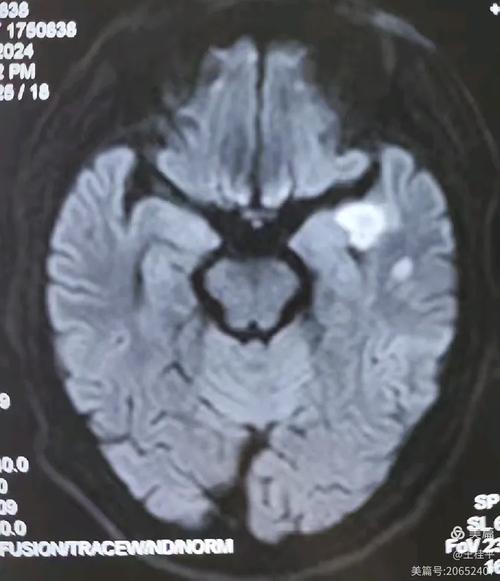 做脑核磁会不会造成脑梗