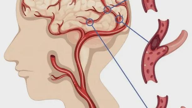 多发腔隙性脑梗 脑路通