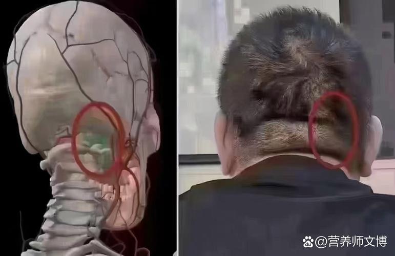 脑脑梗后脑神经会水肿吗