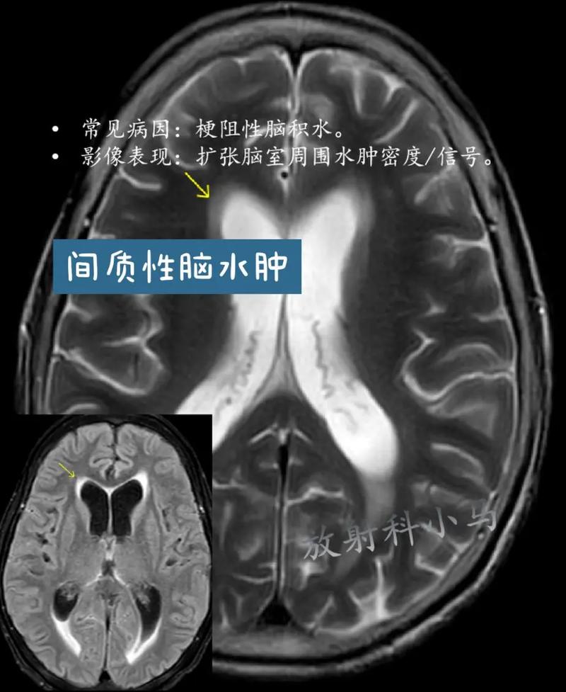 脑脑梗后脑神经会水肿吗
