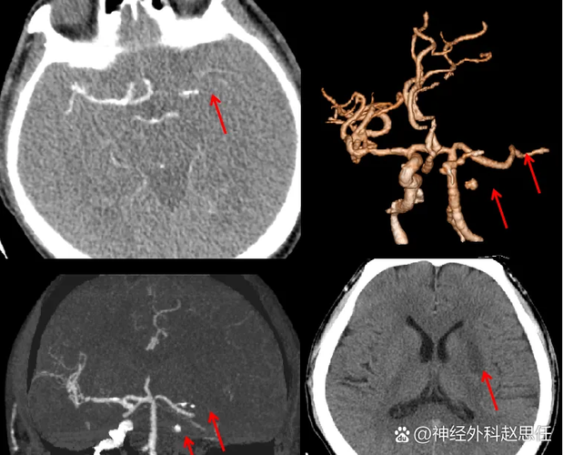急性脑梗左脑主干道梗死