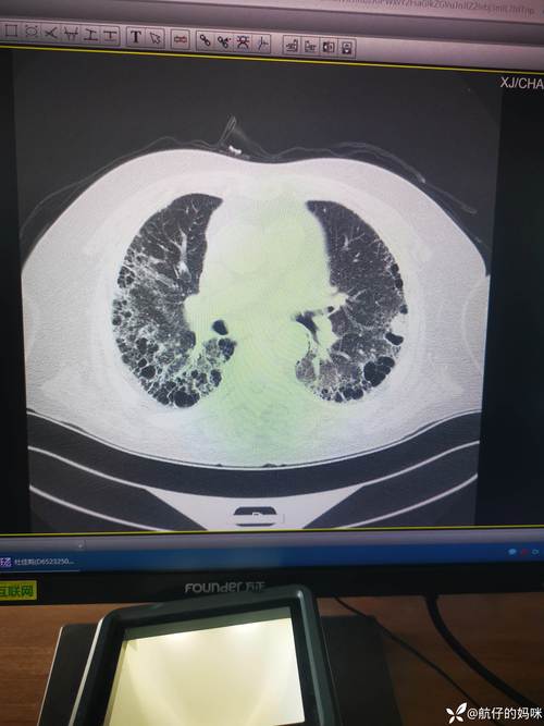 内风湿和类风湿和肺纤维