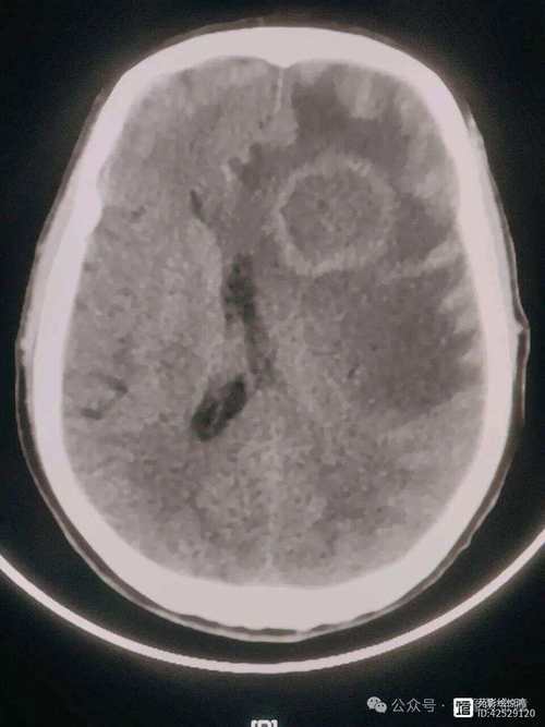 脑梗与脑脓肿的核磁区别