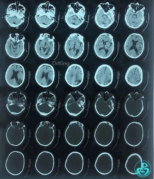 脑彩超能查脑血栓和脑梗