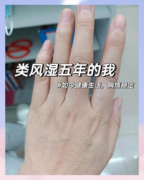 如果风湿或类风湿怎么办