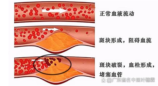 心梗脑梗互相发病的时间