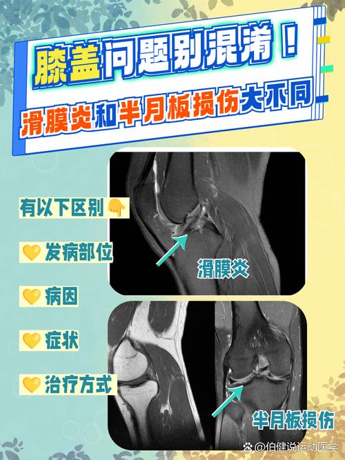 膝关节类风湿和风湿区别