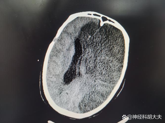 脑梗病人做脑ct空腹吗