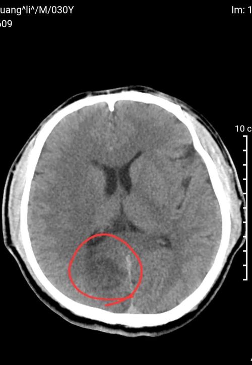 脑CT排除脑梗吗好大夫