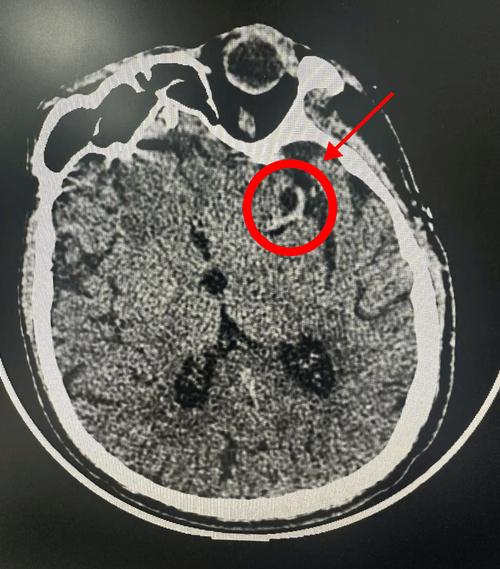 脑CT排除脑梗吗好大夫