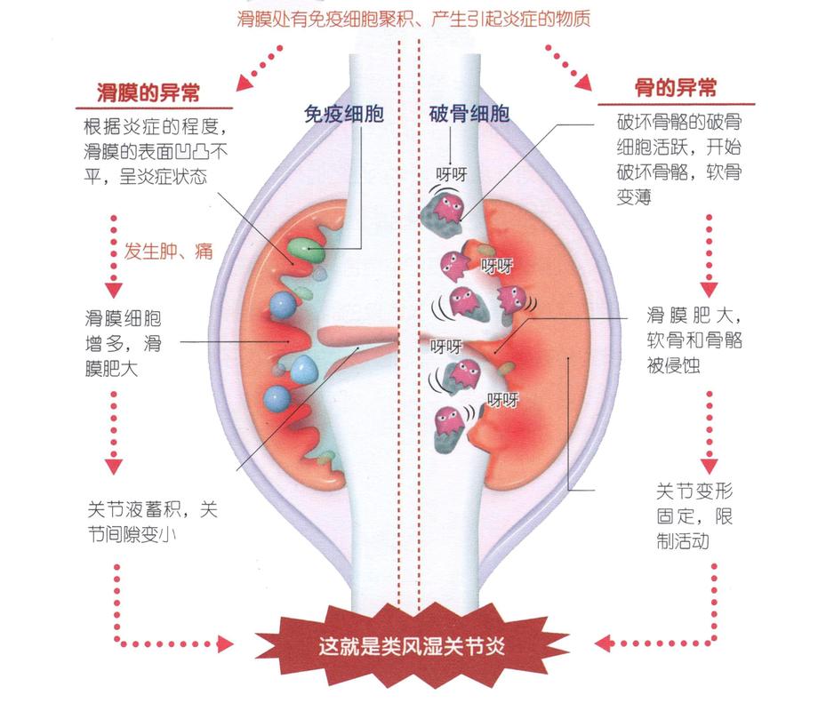 风湿关节炎有风湿因子吗