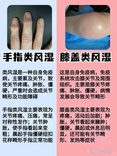 风湿和类风湿应该怎样治