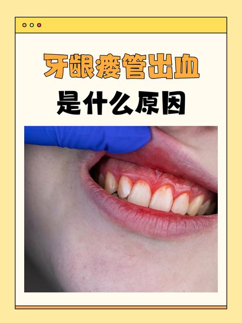 阿司匹林牙龈出血 脑梗