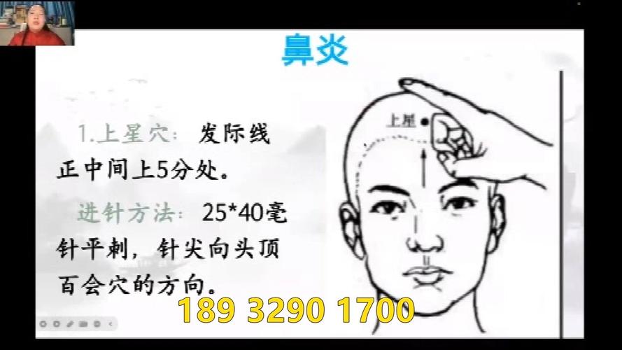 针灸哪些穴位治疗鼻炎