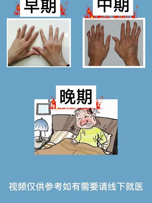 类风湿如风湿有什么不同