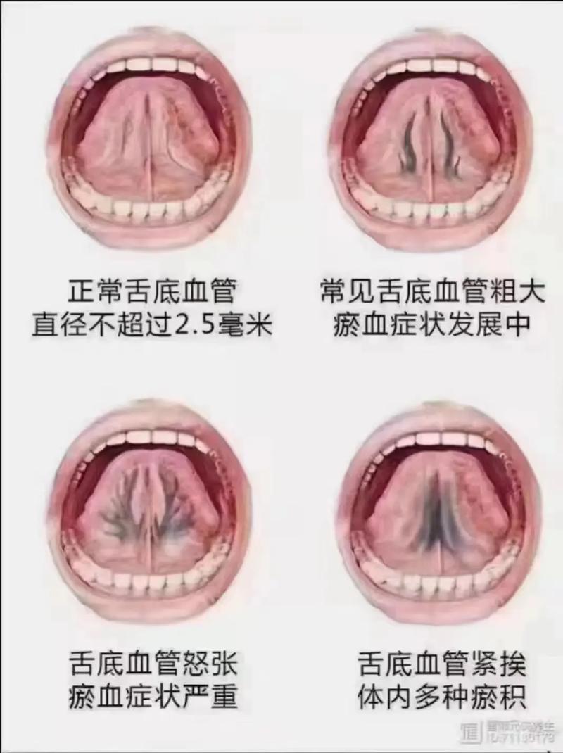 舌尖发麻就是脑梗心梗吗