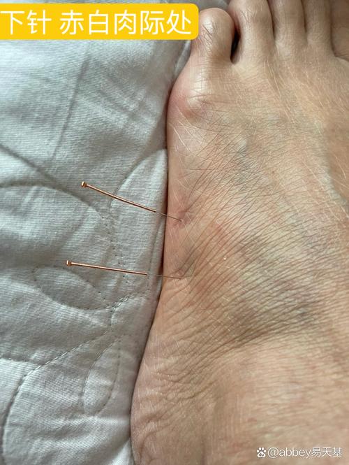 手指肿胀艾灸哪些穴位