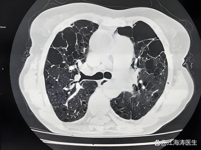 心梗脑梗肺部感染肺气肿