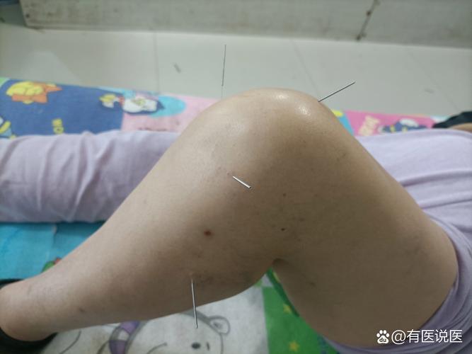 针灸治疗膝盖疼痛穴位