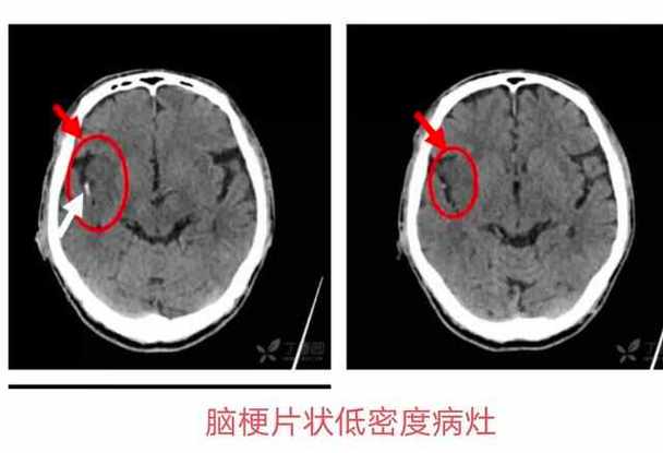 脑内少许腔梗老年脑改变