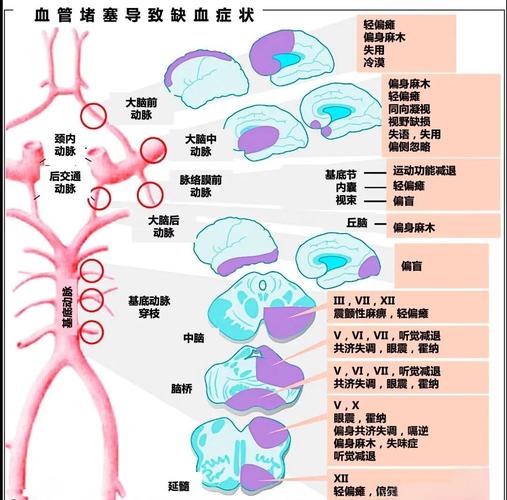 脑动脉闭塞和脑梗的区别