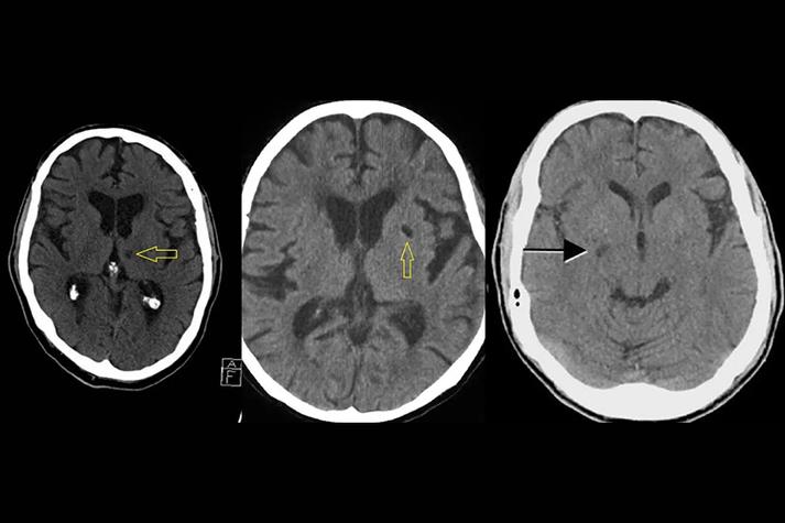 脑梗的脑ct片子如何看