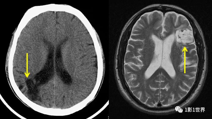 脑梗与脑软化灶影像区别