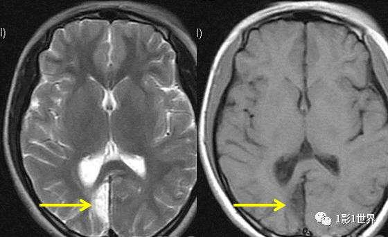 脑梗与脑软化灶影像区别
