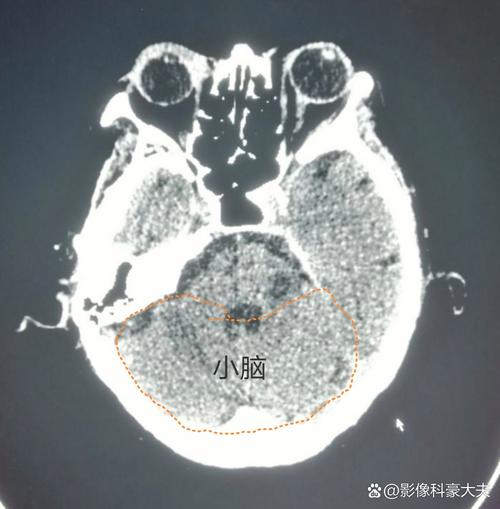 做脑CT可以查到脑梗吗