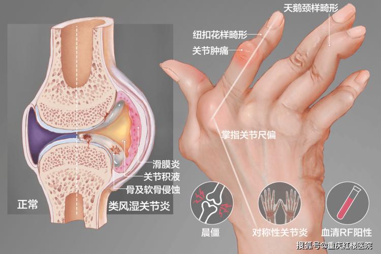 小关节是风湿还是类风湿