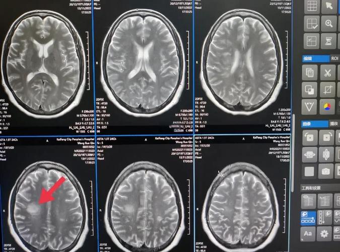 脑核磁能查出早期脑梗吗