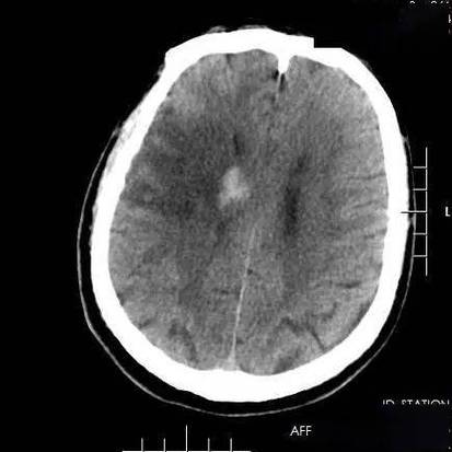 做完脑CT说之前有脑梗