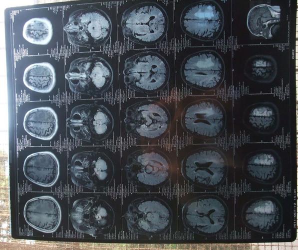 脑CT显示脑内多发腔梗