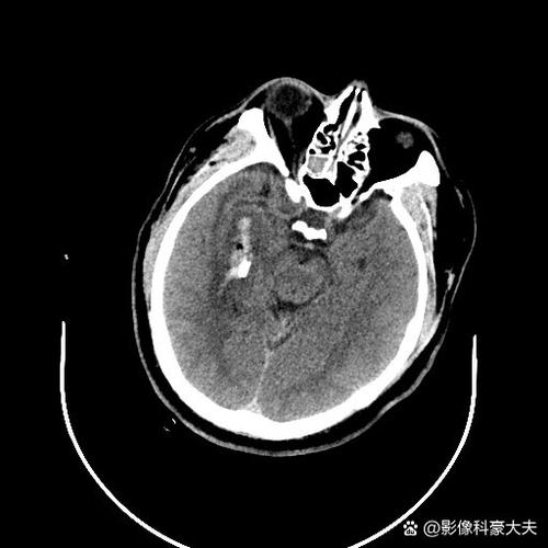 脑CT显示脑内多发腔梗