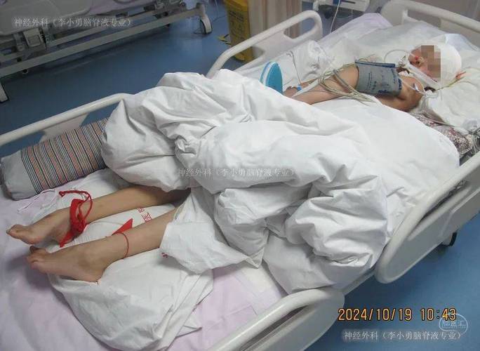 脑梗后积水脑压过高开颅