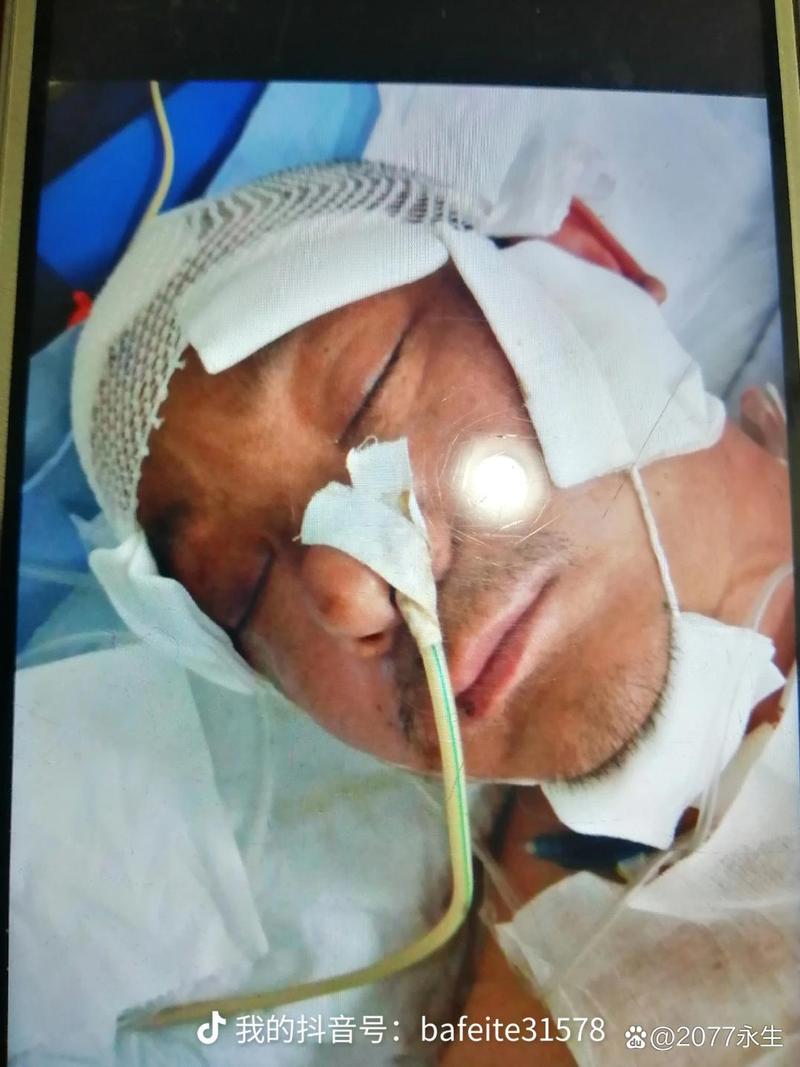 脑梗后积水脑压过高开颅