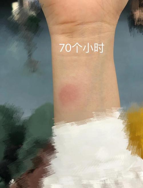 类风湿抽血阴性为类风湿