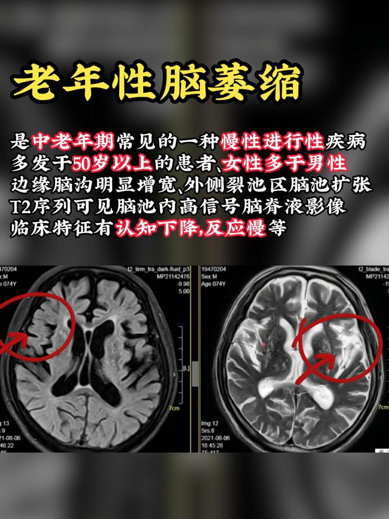 脑梗严重还是脑萎宿严重