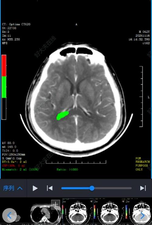 出现脑梗前兆脑ct正常