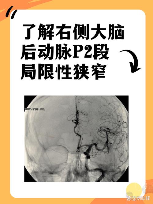 脑梗复发外加脑动脉硬化