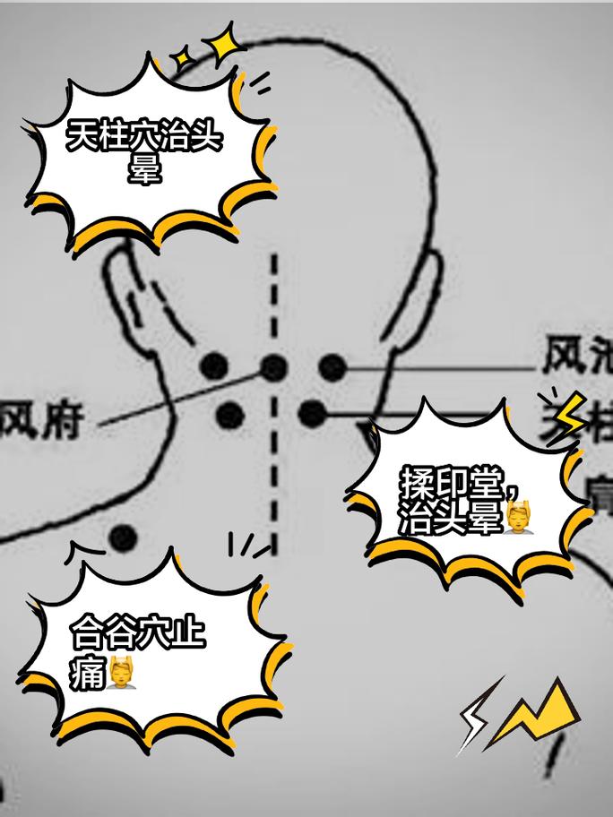 脑干梗塞昏迷针灸穴位